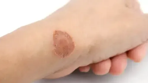 What is the Best Home Remedy for Ringworm?